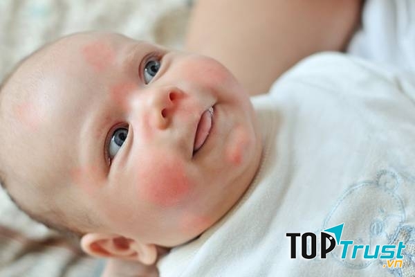 Trẻ dị ứng trứng gà