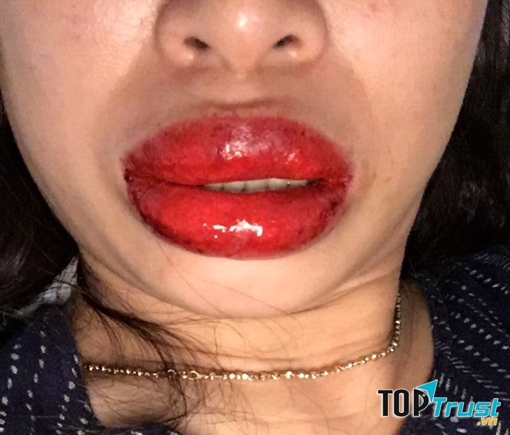 Dị ứng với mực xăm