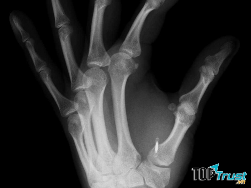 Điện thoại cấy ghép giúp theo dõi tình trạng sức khỏe bệnh nhân