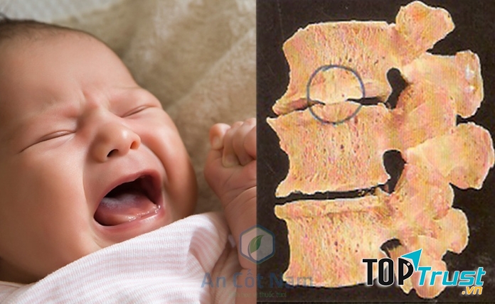 Thoát vị đĩa đệm do một số bệnh lý cột sống bẩm sinh