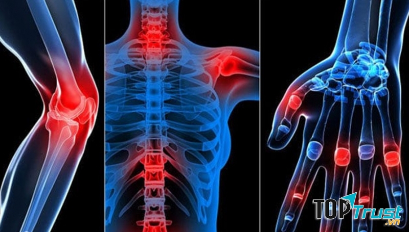 bệnh về khớp cũng không tránh khỏi nguyên nhân là do vi rút từ các bệnh khác gây nên.