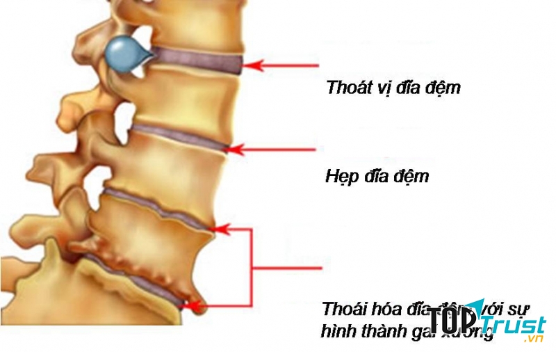 Virut của thoát vị đĩa đệm ảnh hưởng đến xương khớp