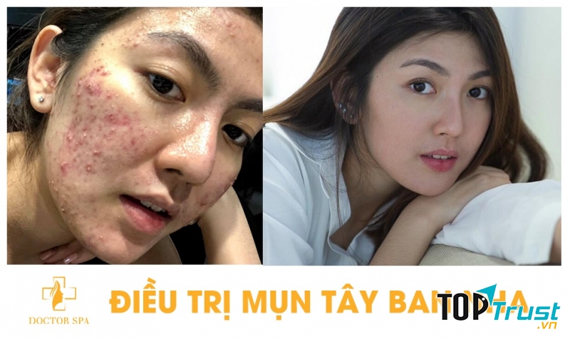 Doctor Spa - Trị Mụn Chuyên Sâu