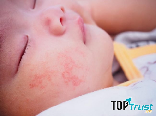 Đối với các bé trên 1 tuổi bị dị ứng đạm sữa bò