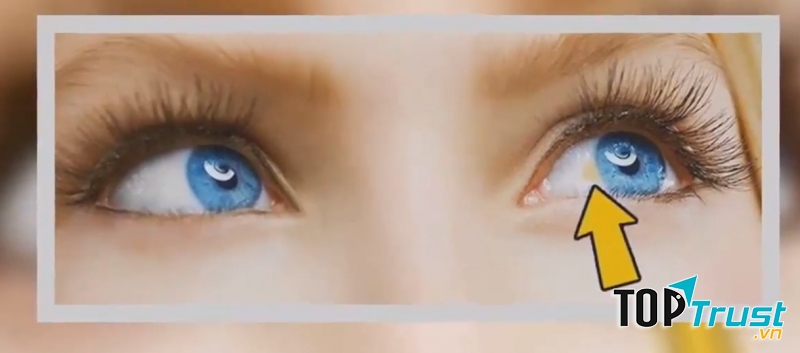 Đốm trắng trên giác mạc