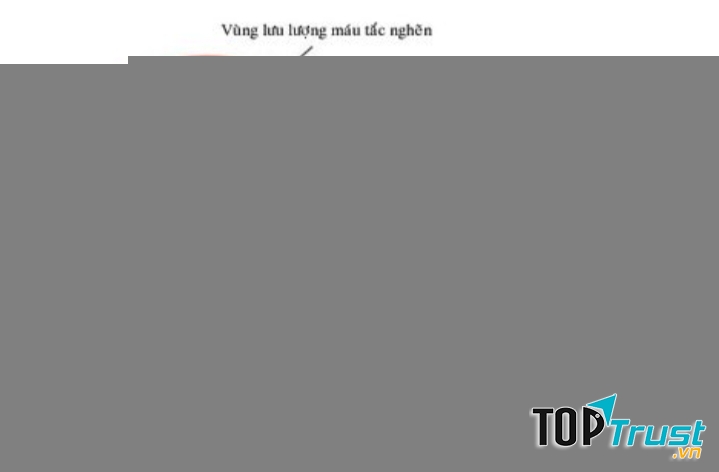 Nguyên nhân gây đột quỵ là do sự bất ổn của tuần hoàn máu não