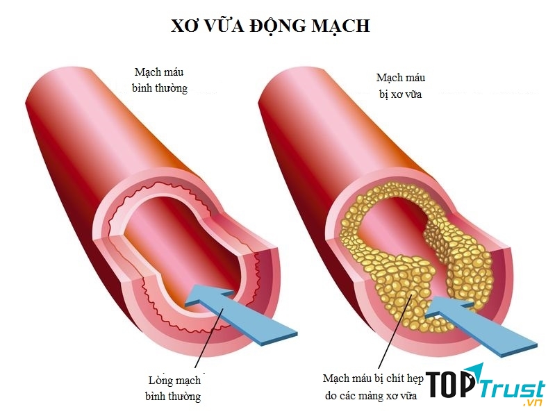 Bệnh xơ vữa động mạch