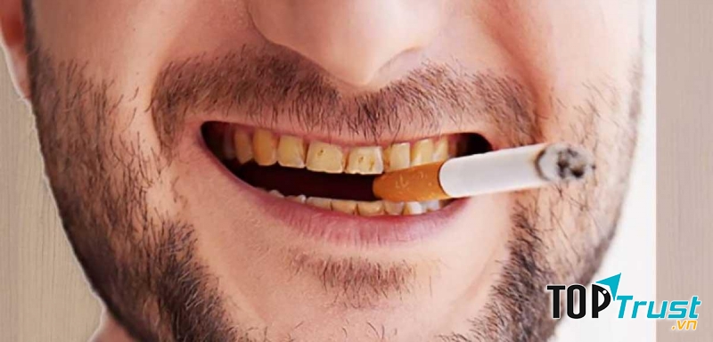 Hút thuốc lá gây ố vàng răng và rụng răng