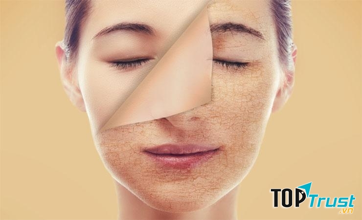 Gây sạm da, khô da