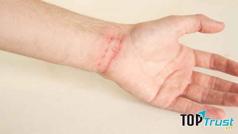 Bệnh lây từ người này sang người khác thông qua tiếp xúc trực tiếp hoặc qua quần áo, chăn chiếu dính trứng ghẻ hoặc cái ghẻ.