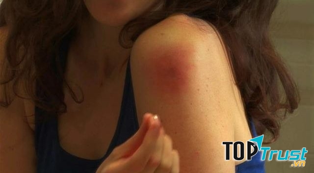 Lá tía tô còn có tác dụng giải nọc độc khi bị ong đốt