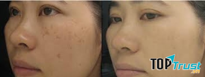 Giảm đốm da