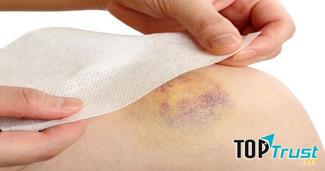 Giảm vết bầm tím trên cơ thể