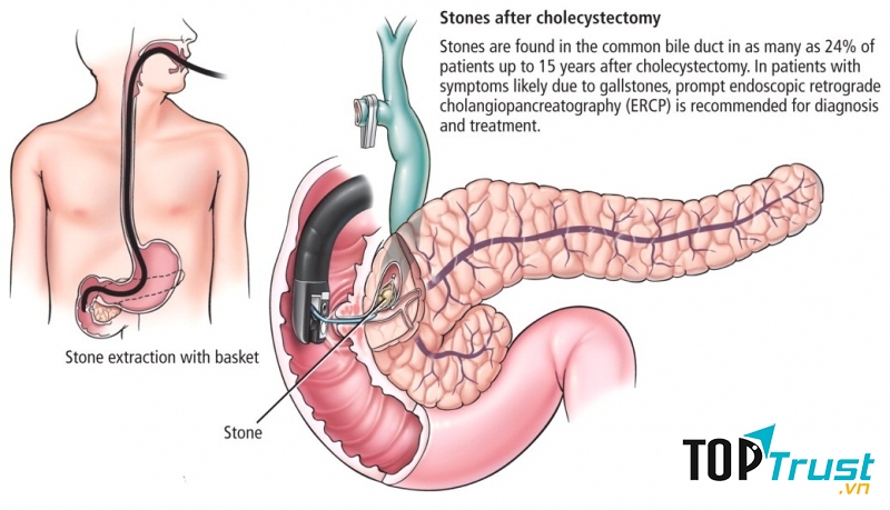 Giun chui ống mật