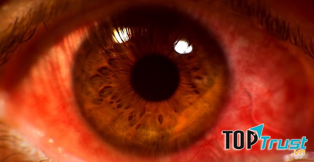 Giun kí sinh trong mắt.