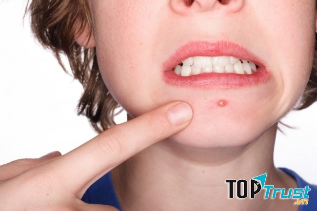 Giúp giảm mụn trứng cá