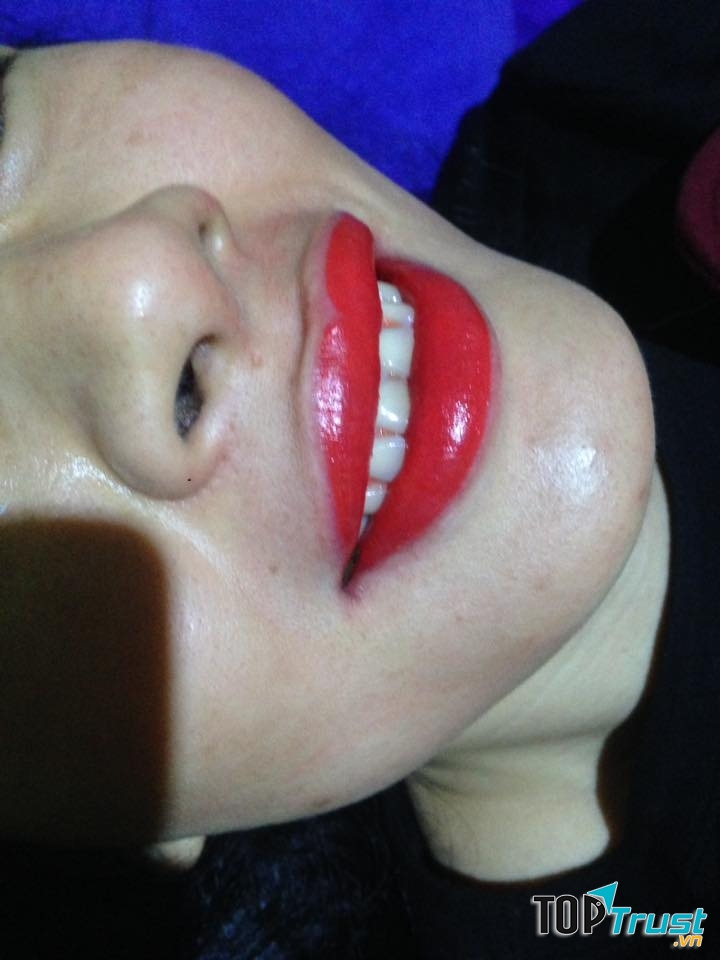 Hình ảnh môi khách hàng ngay sau khi làm xong - rất tự nhiên, không hề bị sưng.