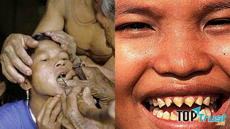 Hàm răng nhọn như cá mập vẫn còn tồn tại làm tiêu chuẩn cái đẹp