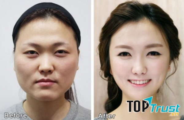 Hàn Quốc có tỉ lệ phẫu thuật thẩm mỹ nhiều nhất thế giới