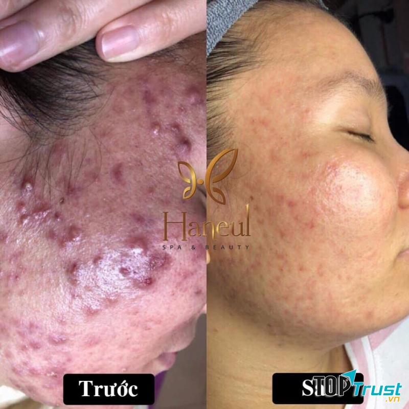Haneul Spa - Thẩm Mỹ Công Nghệ Cao Số 1 Vĩnh Phúc