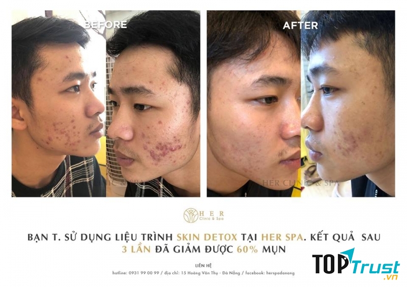Hình ảnh thật của khách hàng đã điều trị mụn tại Her Clinic and spa