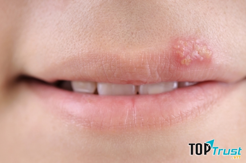 Khi mẹ bị nở miệng thì không nên hôn trẻ