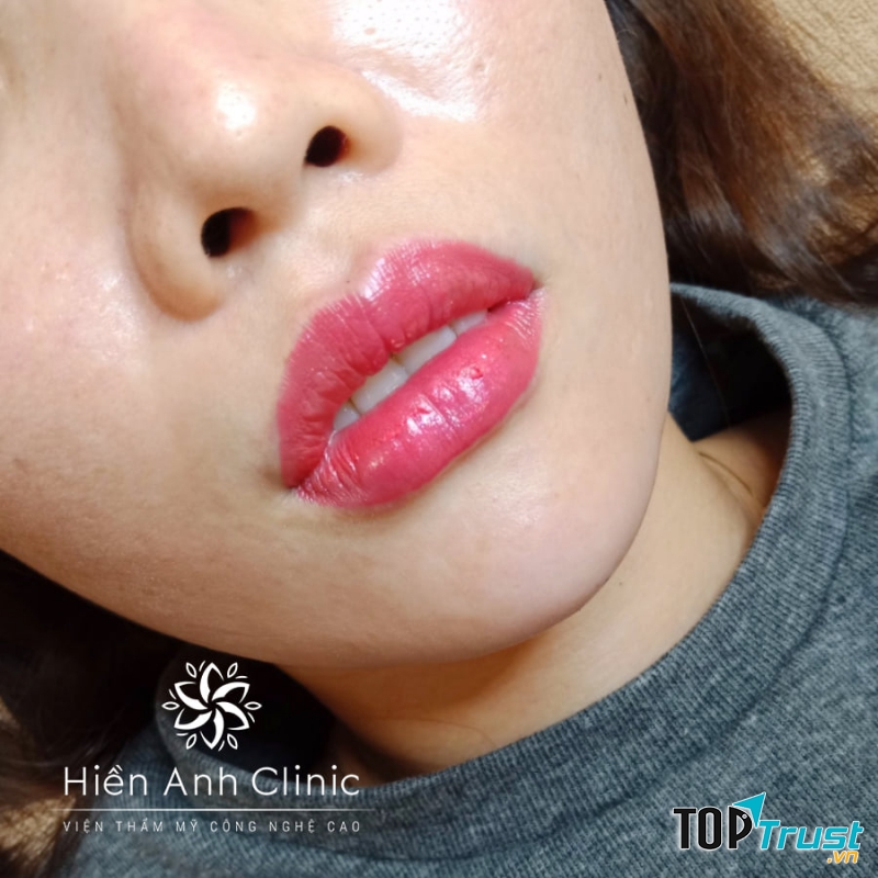 Phun xăm thẩm mỹ tại Hiền Anh Clinic