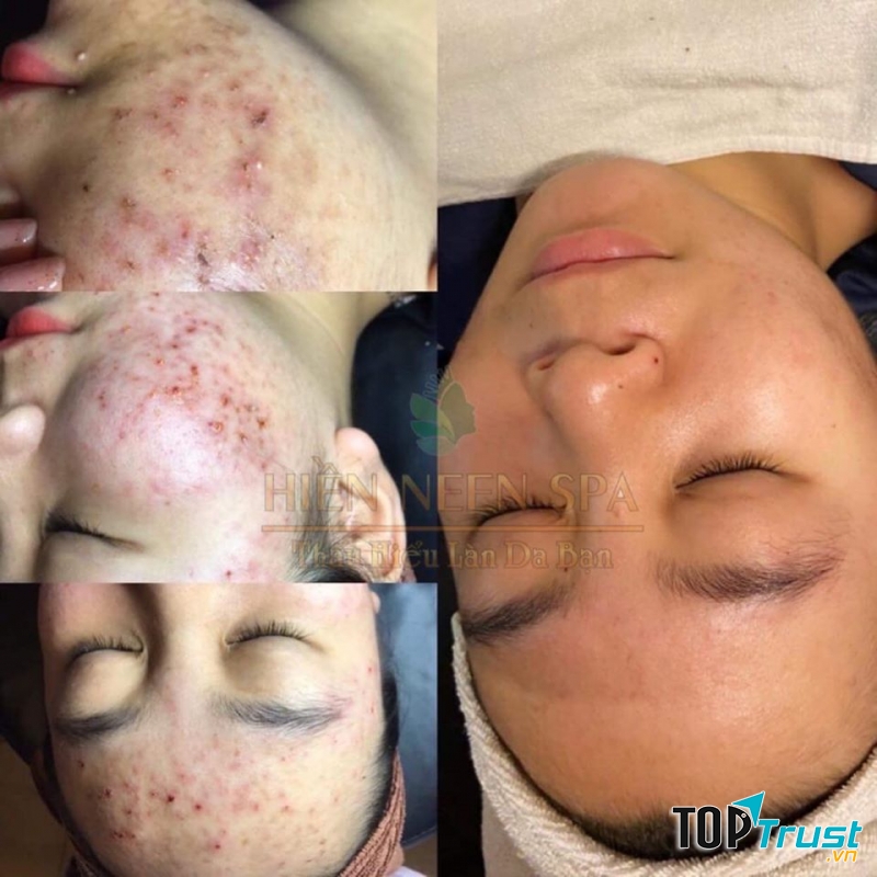 Hiền Neen Spa