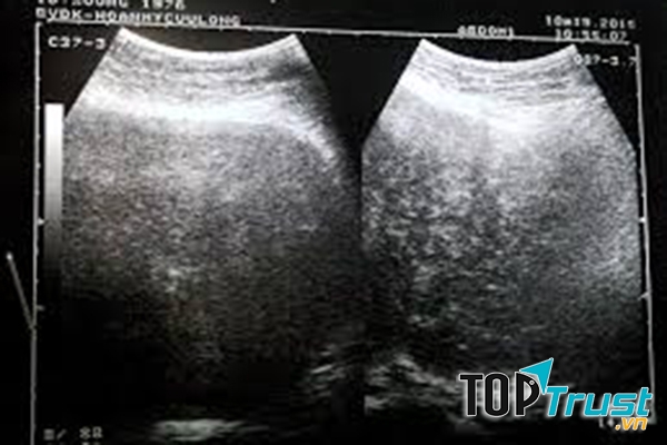 Có khoảng 10% phụ nữ trong độ tuổi sinh đẻ bị bệnh buồng trứng đa nang.