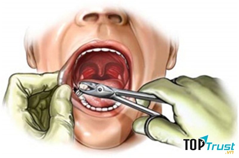 Hội chứng Lesch-Nyhan