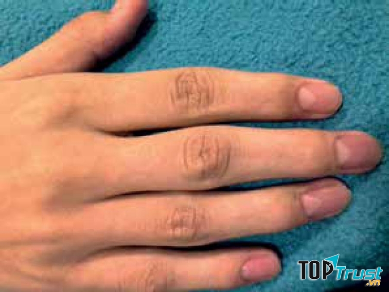 Hội chứng móng tay xương bánh chè (nail-patella syndrome)