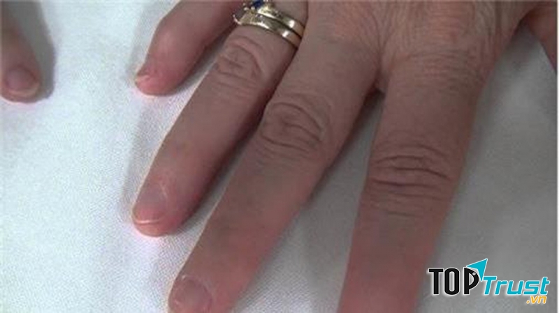 Hội chứng móng tay xương bánh chè (nail-patella syndrome)