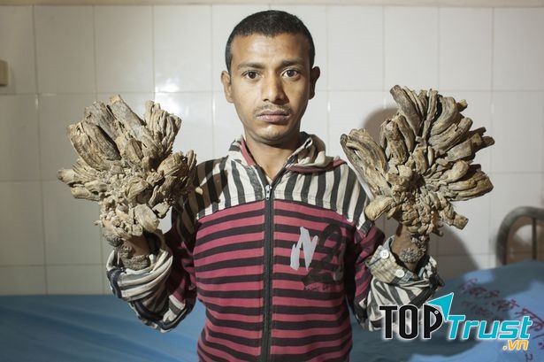 Hội chứng người cây (Epidermodysplasia Verruciformis)