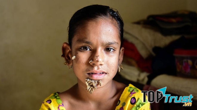 Hội chứng người cây (Epidermodysplasia Verruciformis)