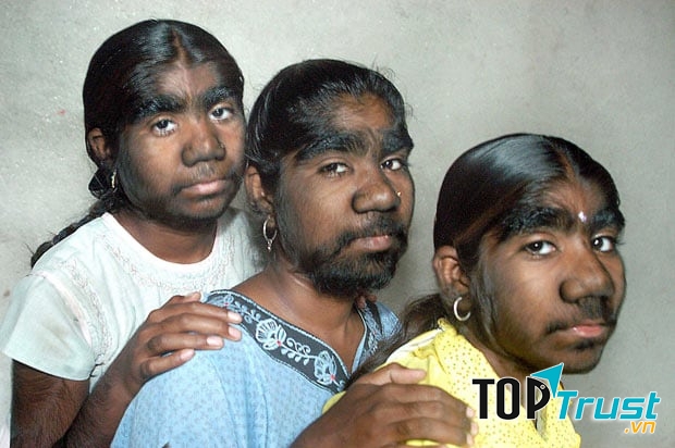 Hội chứng người sói