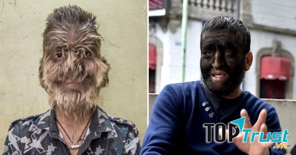 Hội chứng người sói