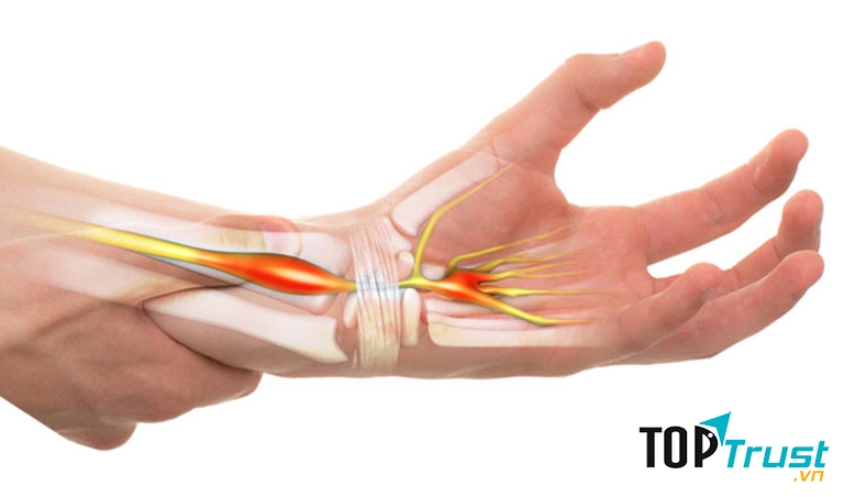 Hội chứng ống cổ tay