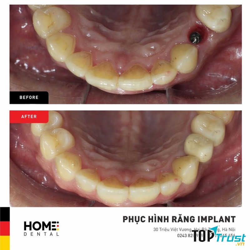 Home Dental - Nha Khoa tiêu chuẩn Đức