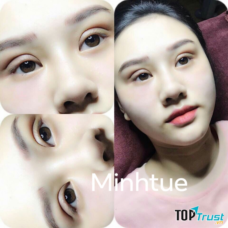 Cắt mí tại Minh Tuệ spa
