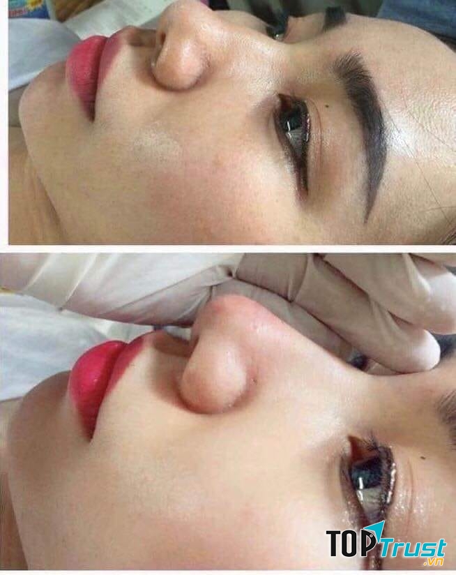 Tiêm Mũi Filler nhanh chóng đẹp ngay và luôn tại Linh VioSpa