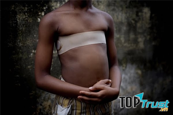 Hủ tục làm phẳng ngực