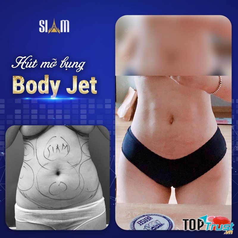 Hút - Cấy mỡ Body Jet - Viện Thẩm mỹ SIAM Thailand