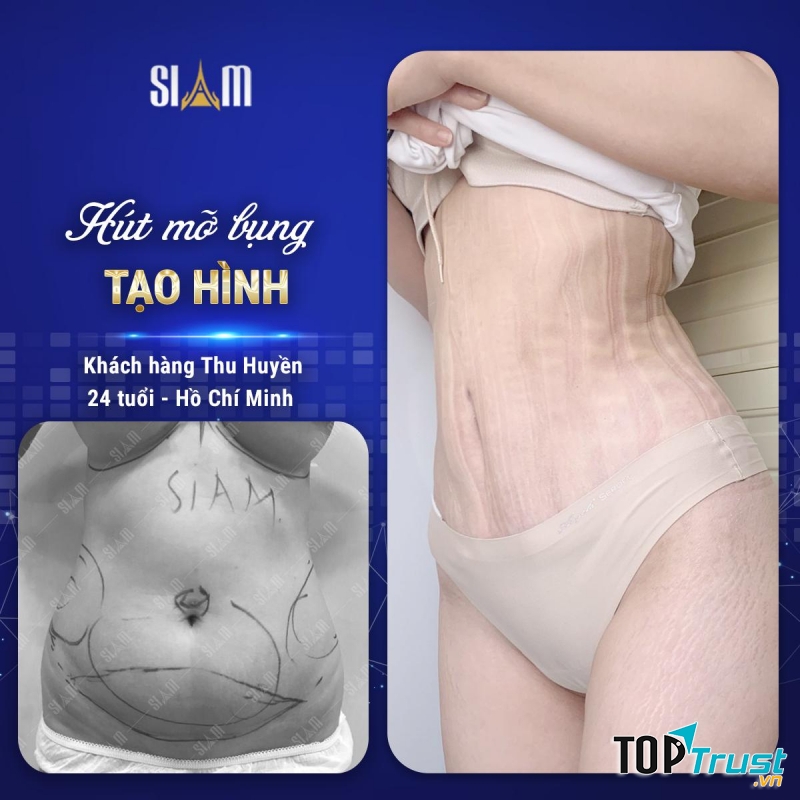 Hút - Cấy mỡ Body Jet - Viện Thẩm mỹ SIAM Thailand