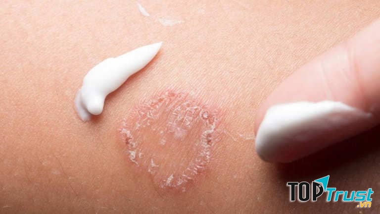 Thuốc Ketoconazole trị hắc lào.