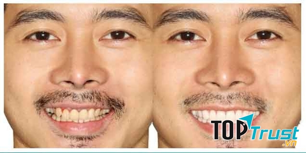Denta Seal là một loại kem đánh răng độc nhất vô nhị. Đây cũng là loại kem đánh răng làm trắng răng có chứa nano Hydroxyapatite.