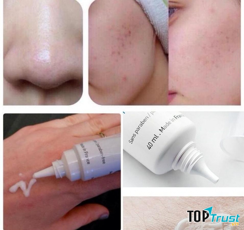 Thành phần của kem trị mụn La Roche Posay Effaclar Duo+ gồm có: Procera  giúp điều trị tận gốc các vết thâm đỏ do mụn gây ra.