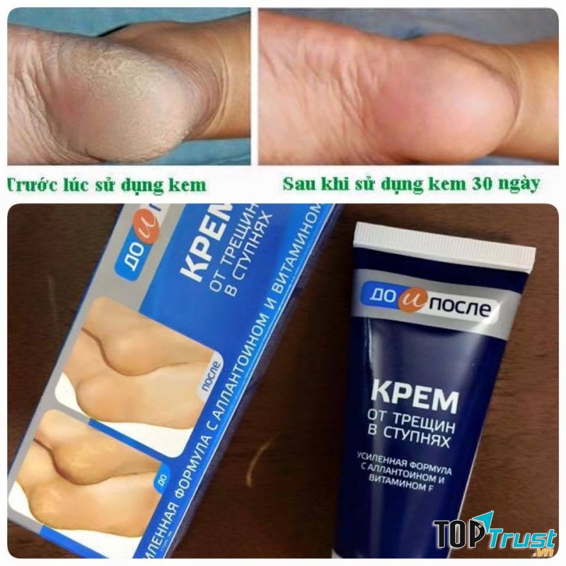 Kem trị nứt gót chân Kpem Apteka