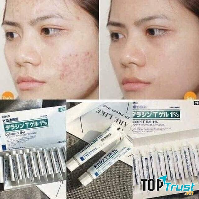 Kem trị thâm mụn Dalacin