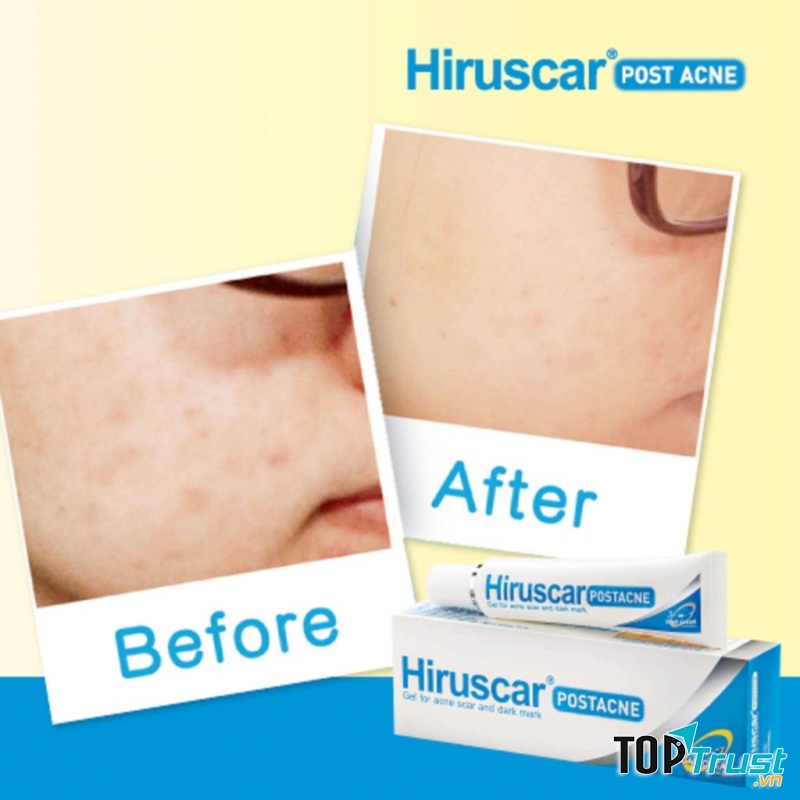 Kem trị thâm mụn Hiruscar