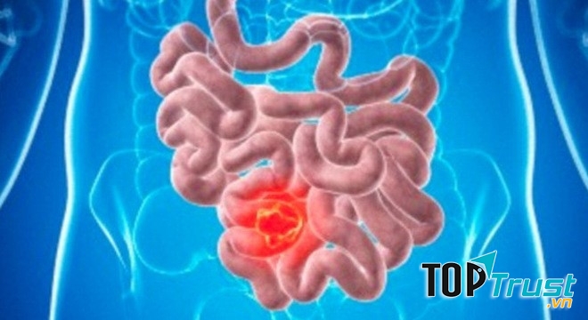 Khả năng mắc bẹnh ung thư cao hơn